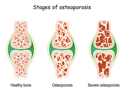 Stages of Osteoporosis