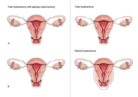 Hormone Replacement Therapy and its Role in Treatment Following Hysterectomy