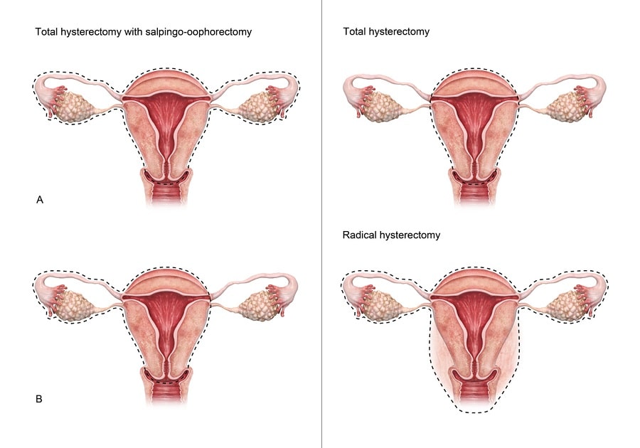 Hysterectomy and Oophorectomy
