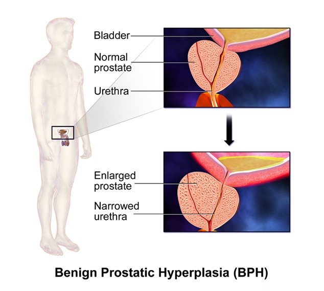 Benign Prostatic Hyperplasia