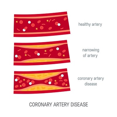 healthy artery and coronary artery desease