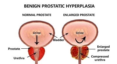 Benign Prostate Enlargement (BPE) vs. Prostate Cancer