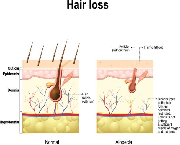 normal hair loss vs alopecia in women