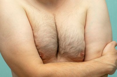 What Are Man Boobs and How to Get Rid of Them Without Surgery?