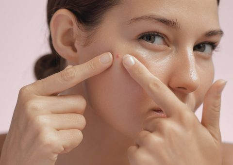 Cystic Acne: Causes, Treatment, and Prevention