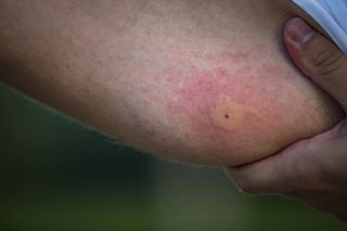 insect sting allergy